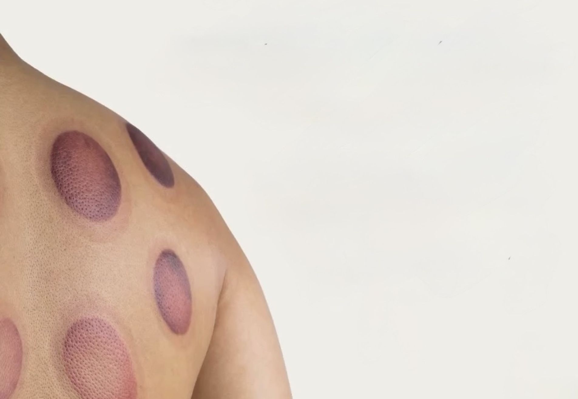 Cuppingmassage  - 60 min