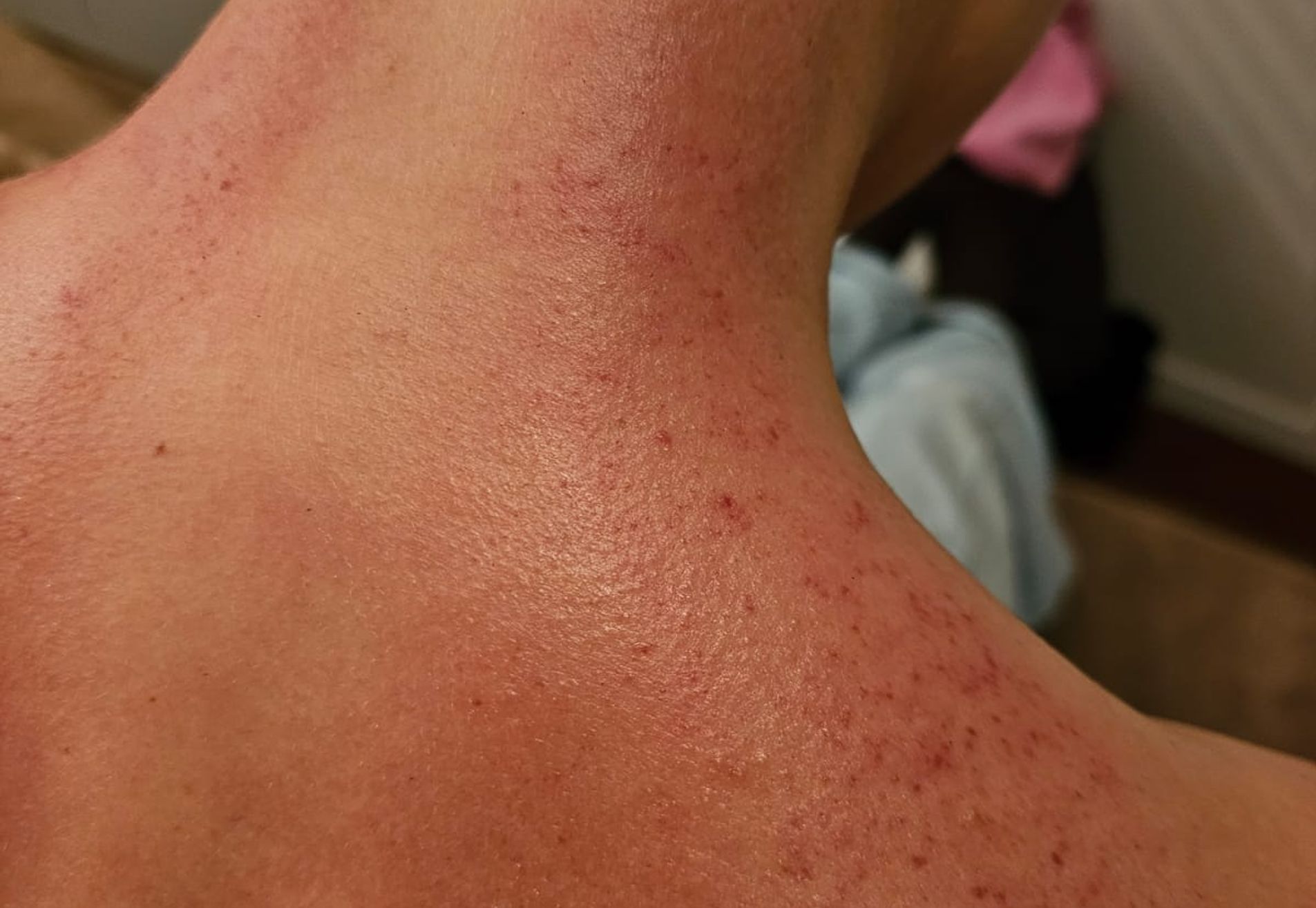 Gua Sha massage