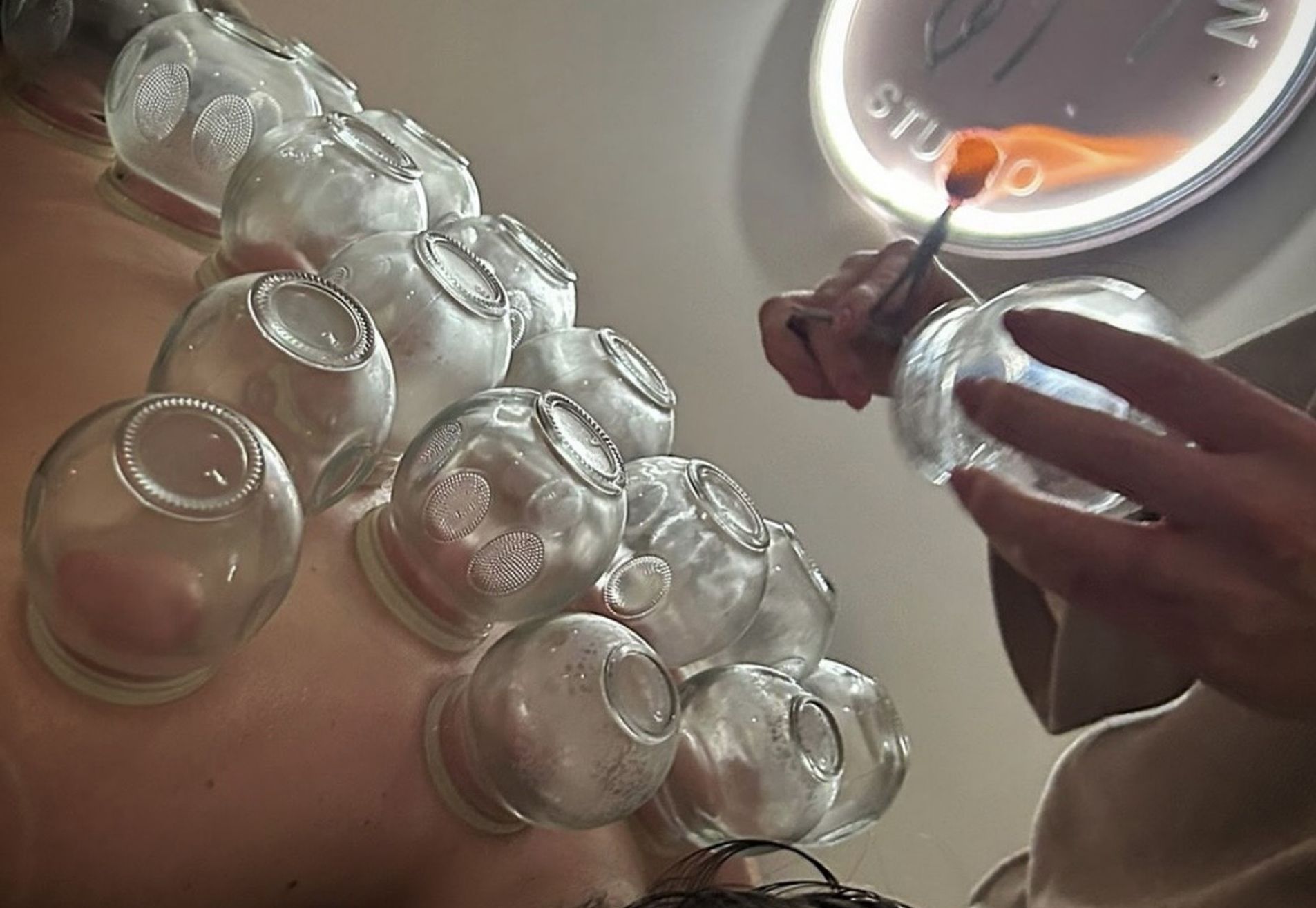 Vuurcupping
