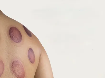 Cuppingmassage  - 60 min