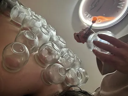 Vuurcupping